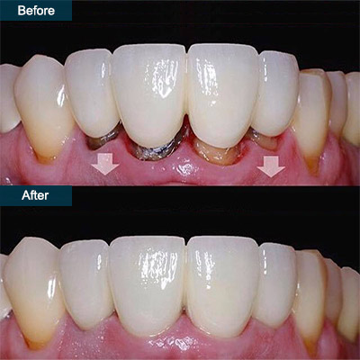 Gum Surgery
